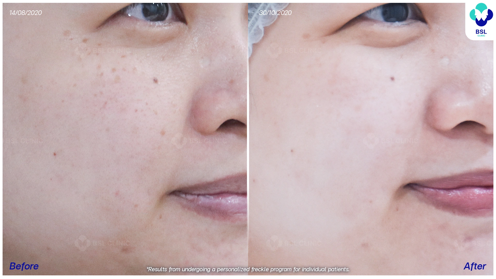 before after กระตื้น