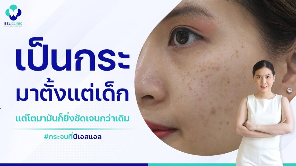 หน้าเป็นกระ