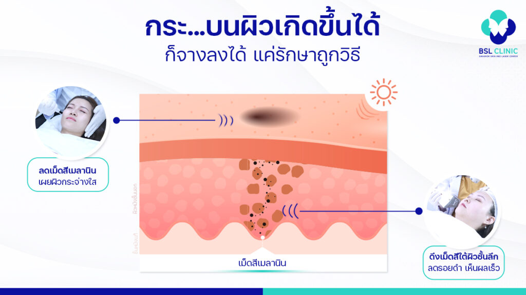 กระ เกิดจากอะไร