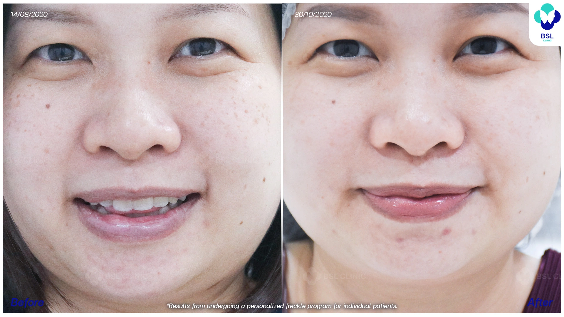 before after กระตื้น