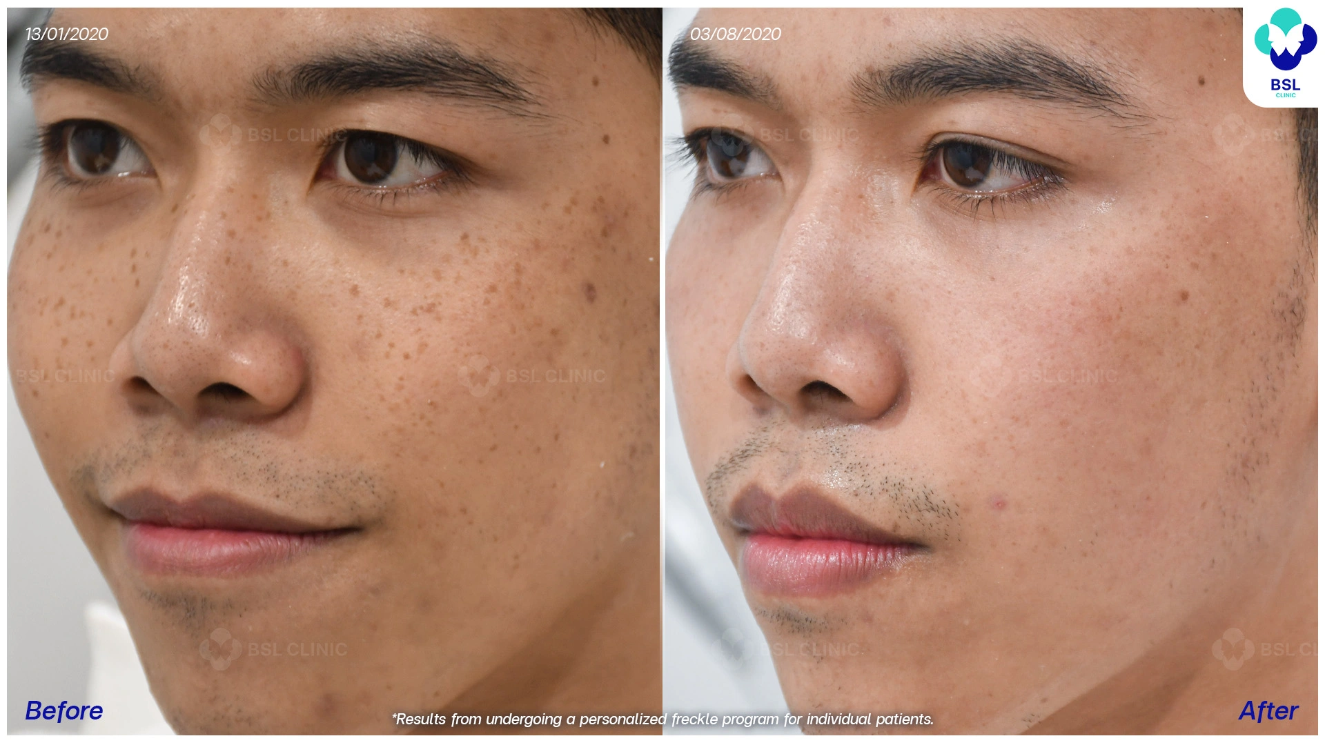 รีวิวรักษากระ