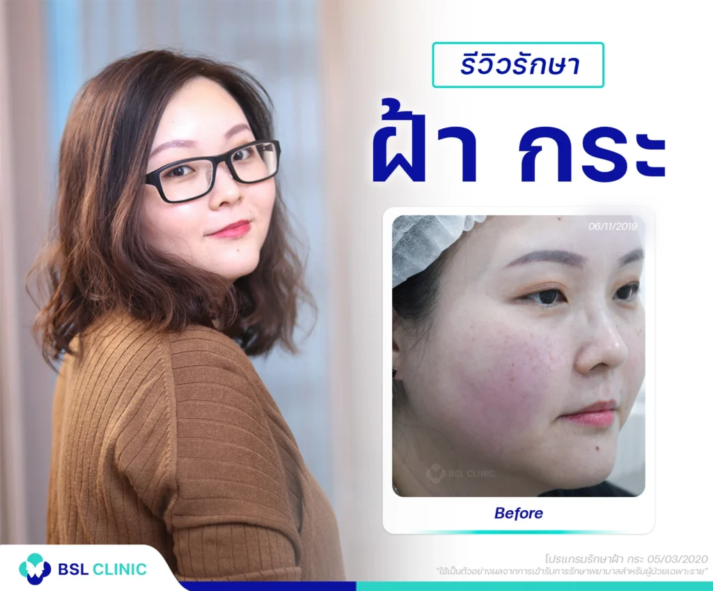 รักษากระ ที่ไหนดี