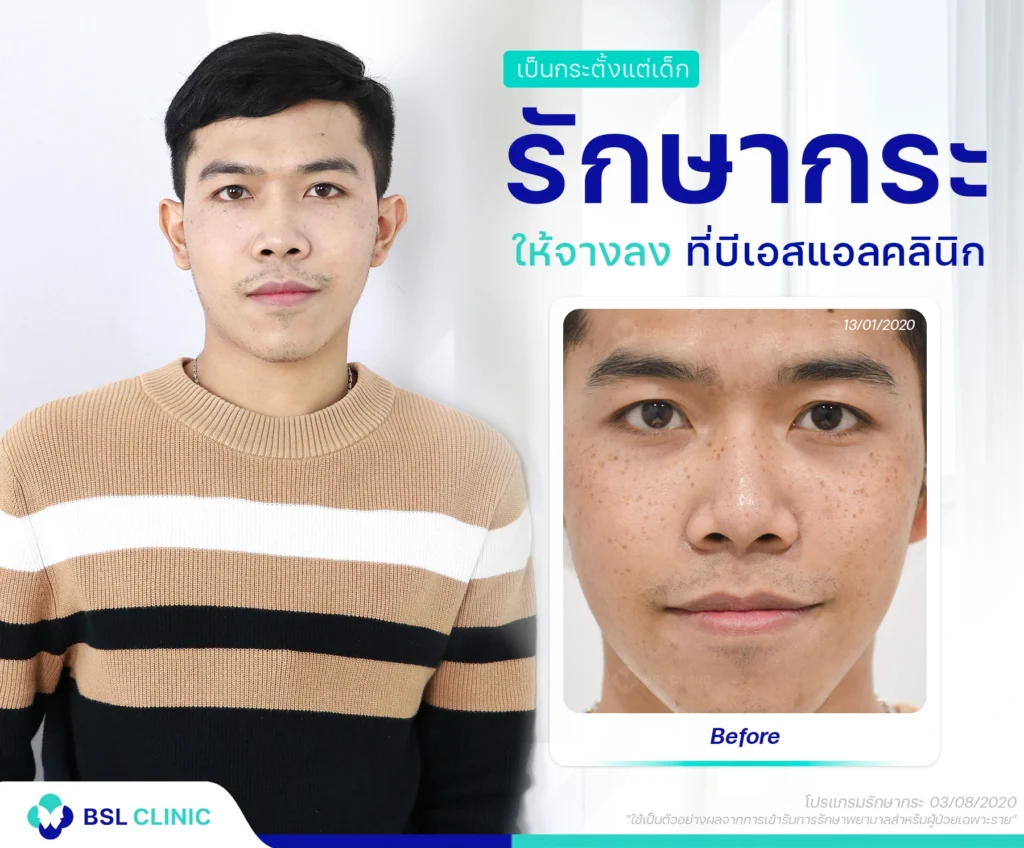 รีวิวรักษากระ