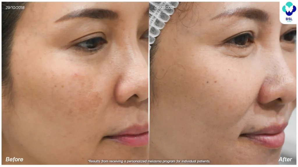รีวิว รักษาฝ้า ที่บีเอสแอล คลินิก