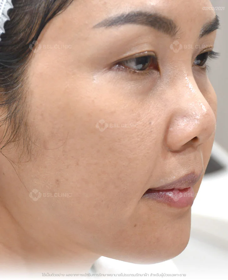 ผลการรักษาฝ้าแดด-ฝ้าสะสม-ฝ้าฮอร์โมน-After