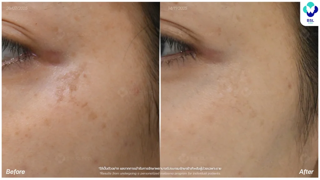 Before After ฝ้าแดด ฝ้าโหนกแก้ม